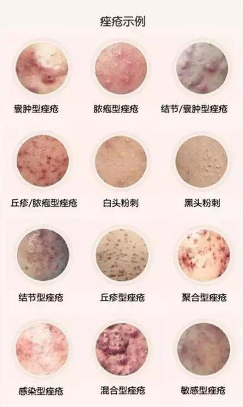 2炎性期 炎性期痤 1,护肤品能治疗痤疮.