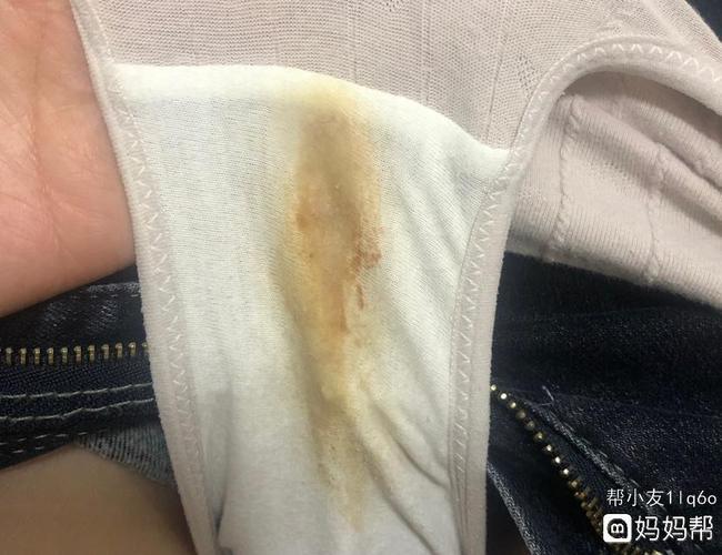 请问是褐色分泌物么?(介意慎点)