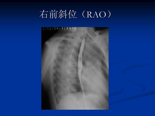 右前斜位(rao)
