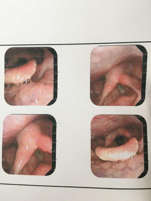 咽喉部粘膜稍充血肿胀双侧劈裂肿胀 糜烂性胃炎