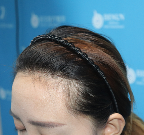 种植发际线 项目分类:植发养发 植发 种植发际线