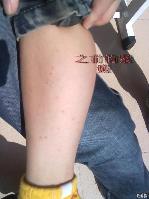 请各位老师关心小儿的紫癜