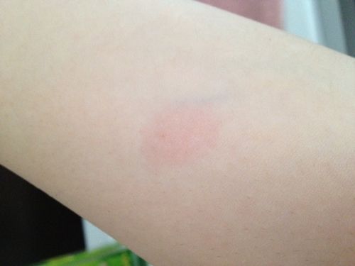 我做ppd皮试一天后针口周围有些红但摸上去并不硬.