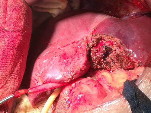 精准肝切除治疗肝胆管结石(循胆管s3段精准切除)