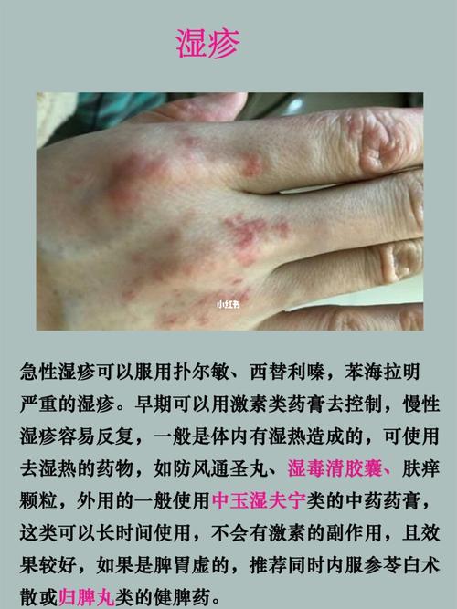 学会辨别皮肤病的种类_皮肤病_皮炎_皮肤问题_湿疹_医疗健康_医疗药品
