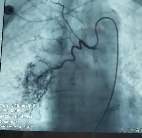 右侧支气管动脉经过造影,发现少量造影剂外溢,证实血管破裂出血
