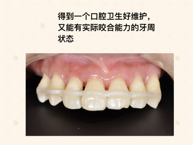 多颗牙松动石英纤维固定术