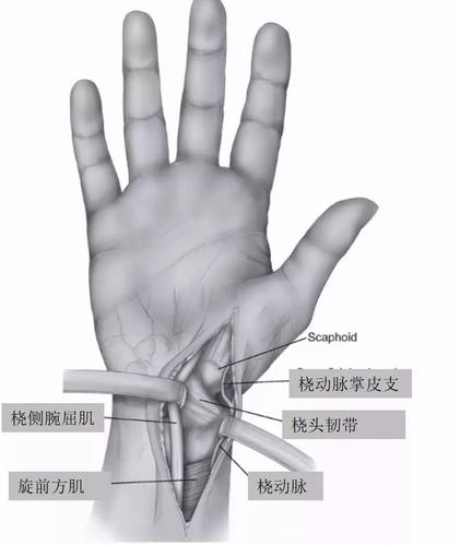 桡动脉牵向桡侧,桡侧腕屈肌牵向尺侧