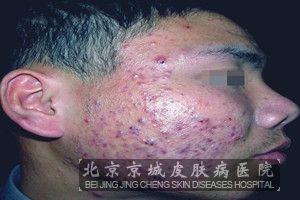 痤疮的图片_痤疮_北京京城皮肤病医院(北京医保定点