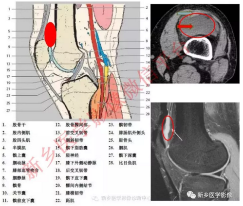 膝关节最大的滑囊,成人后与关节想通,髌上滑膜皱襞常残留.