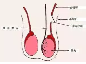 输精管堵塞怎么治?好治吗?