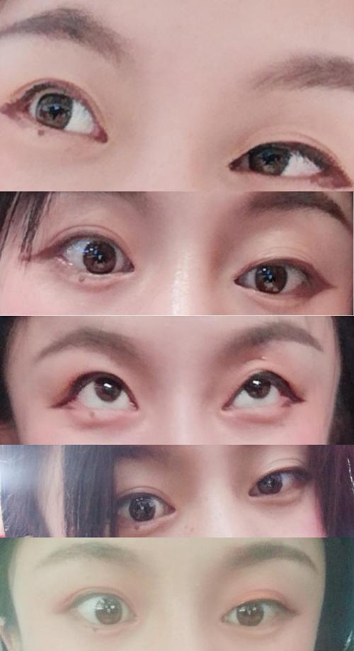 请问上睑提肌一只眼多少钱?