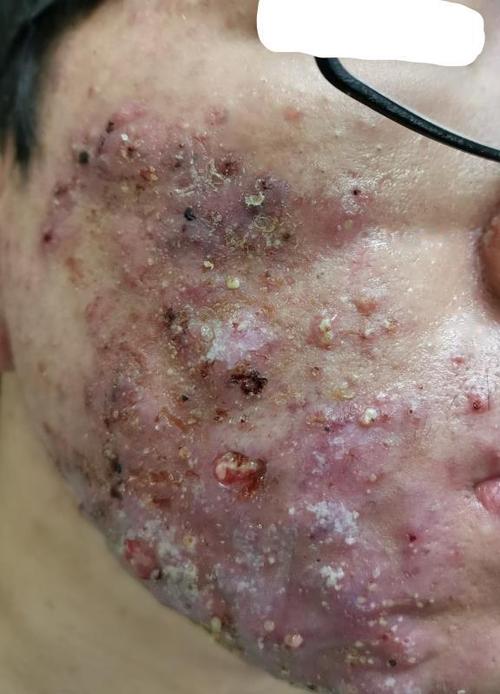 临床病例展示如下:重型痤疮(聚合痤疮等)可伴有炎性丘疹,脓疱,结节