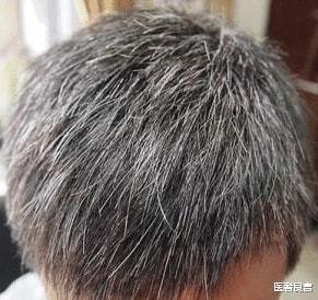 白头发与寿命有什么关系?|酪氨酸|白发_网易订阅