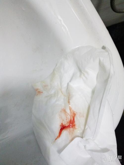 白带上面带点血丝要不要紧