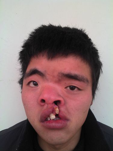 我先天性唇腭裂!特别的严重,家家医院都要好几万快!家