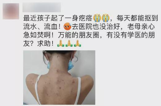 12岁女孩患"不死的癌症",每天抠到流血!这种病极易与湿疹混淆