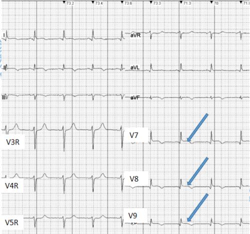 急性心肌梗死的心电图改变
