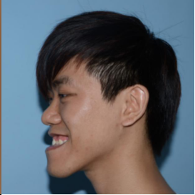 地包天严重脸型图片矫正后变化有多大?