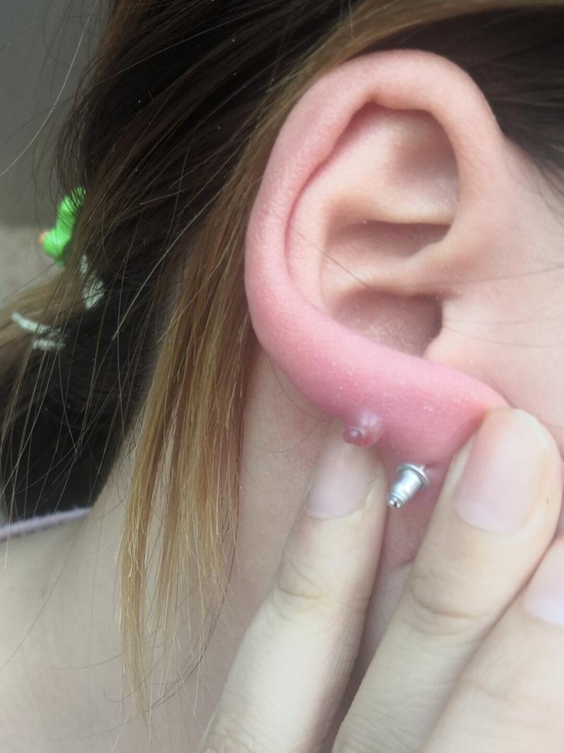 求问!这是不是耳洞增生啊?