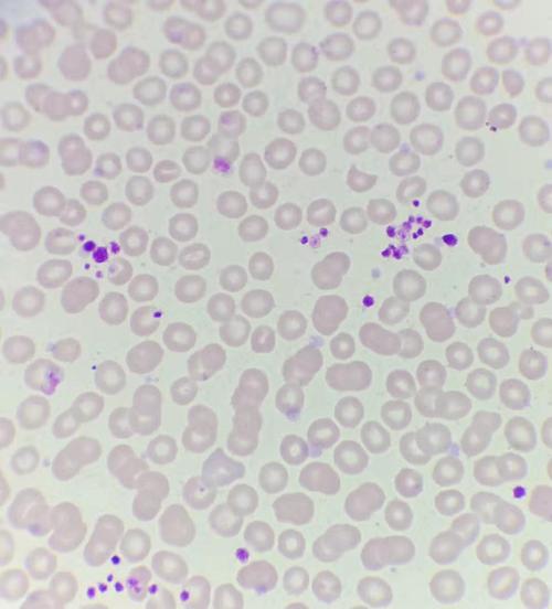 血涂片瑞氏染色x1000 血小板聚集由于edta抗凝剂不影响血细胞的形态