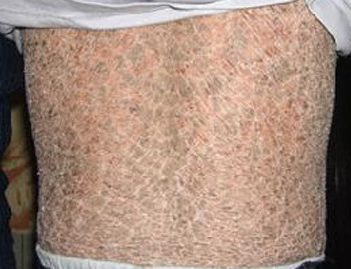 鱼鳞病症状及患病原因