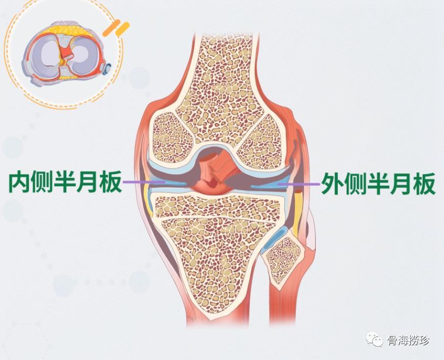 半月板损伤了怎么办?