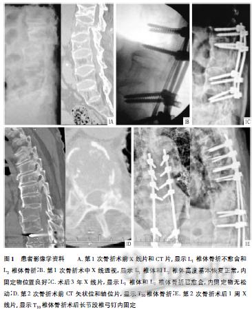 强直性脊柱炎腰椎骨折术后再发胸椎骨折病例分析