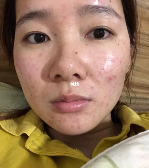 能够留下褐色痘印的位置,通常都有一个【先变红,后变黑】的过程