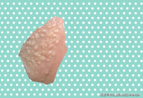 男性容易误诊尖锐湿疣的3种症状:珍珠疹,皮脂腺异位和