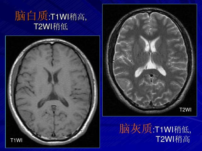 临床医学 脑血管病变mrippt  脑白质:t1wi稍高, t2wi稍低 t2wi 脑灰质