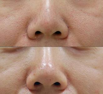 毛孔粗大的形成原因