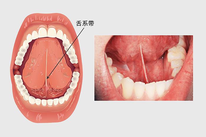 宝宝说话口齿不清,就要剪舌系带?_舌头