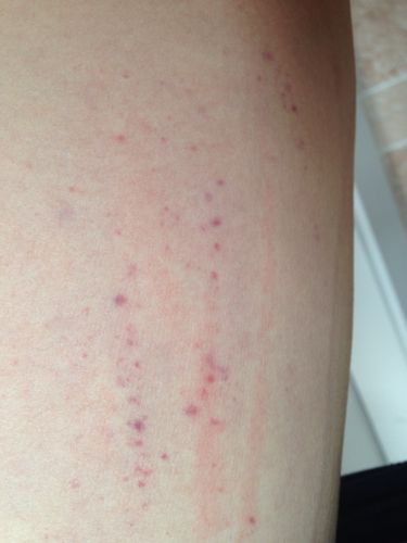 再大腿内侧出现得红点是什么原因呢?