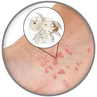 到最后,或可能出现"疥疮结节"的症状,这种就是疥疮最为严重的一种表现