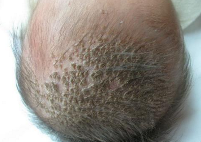 头癣