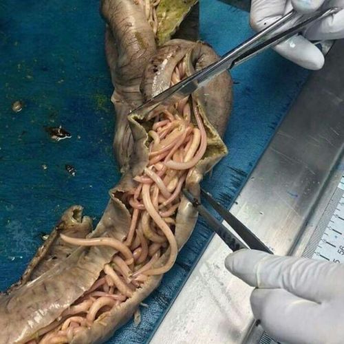 蛔虫性肠梗阻…         显示全部