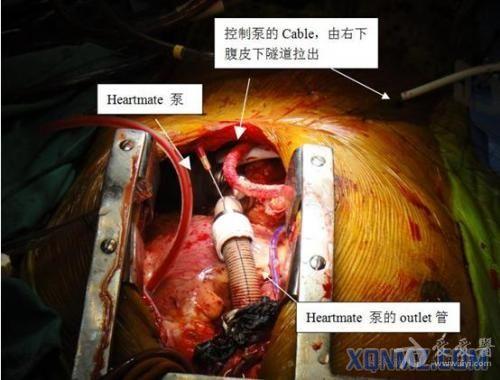 冠心病大国,但是在目前的杜克心脏中心手术室,单纯的cabg已经降到1/3