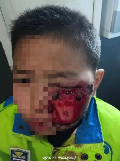 教育 正文 id: nvkan001 2018年2月10日,一名11岁的小男孩被鞭炮炸伤