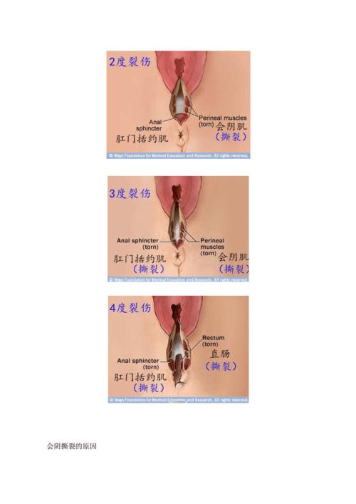 分娩时 会阴撕裂伤分级示意图.docx