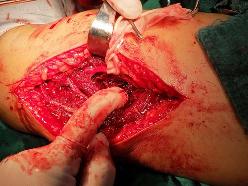 eras理念下治疗肱骨干骨折