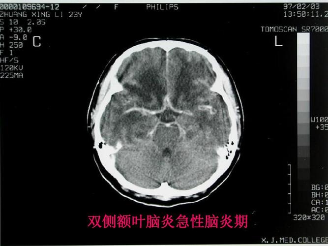 的ct改变ppt  第8页 (共26页,当前第8页) 你可能喜欢 结核性脑膜炎