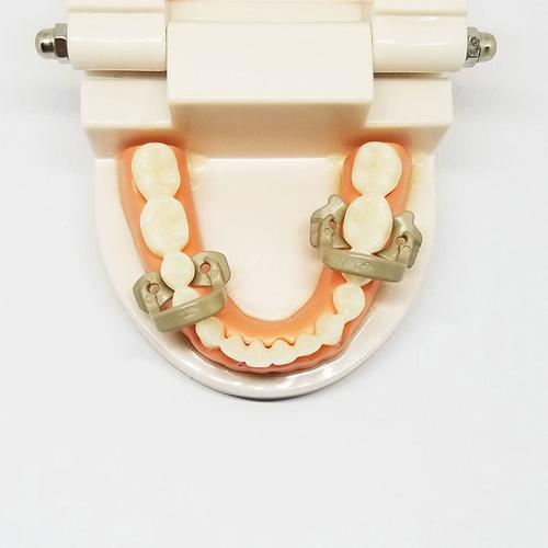 牙科橡皮障树脂夹 橡皮章后牙夹子 橡皮章夹 乳牙树脂