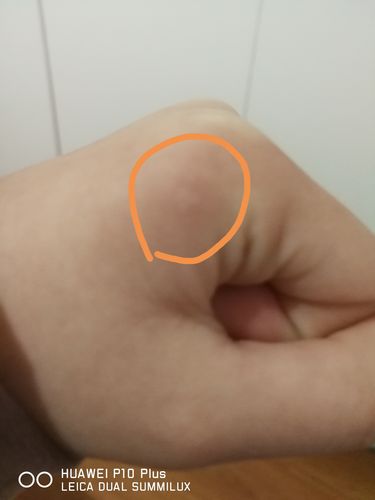 我这是不是被仓鼠咬了,如果是,怎么办?摸起来感觉有点