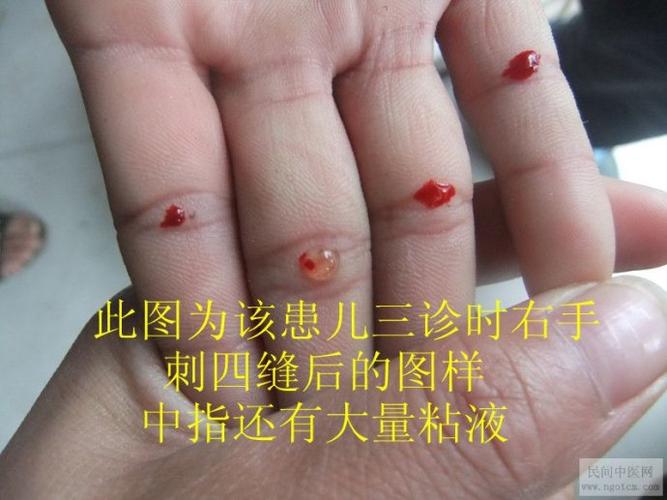 刺四缝过程详细分解图片案例