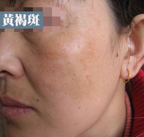 黄褐斑和褐青色痣都容易出现在颧骨周围,该怎么区分?