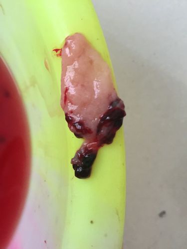 这是孕囊吗?算排感觉了吗?