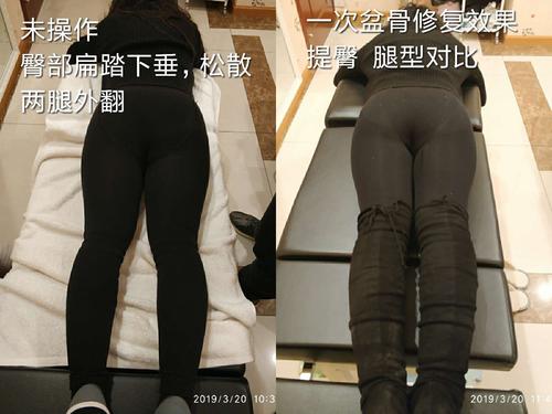 骨雕骨气盆骨闭合收腰提臀术立足传统中医学,经络学,吸收美式骨盆定位