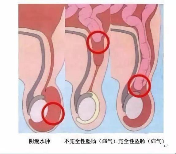腹股沟疝气紧急吗?危险吗?