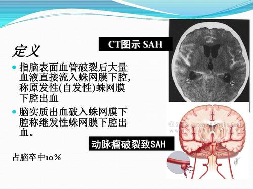 蛛网膜下腔出血诊治流程ppt